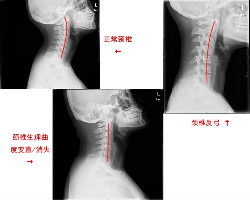 頸椎,錘正療法,錘擊療法